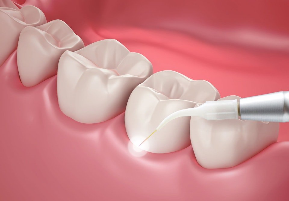 Laser Dentistry viman nagar pune