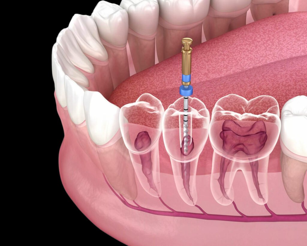 Root Canal Treatment​ viman nagar pune