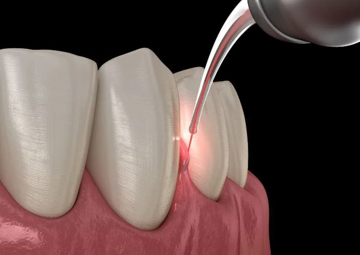 Laser Dentistry viman nagar pune