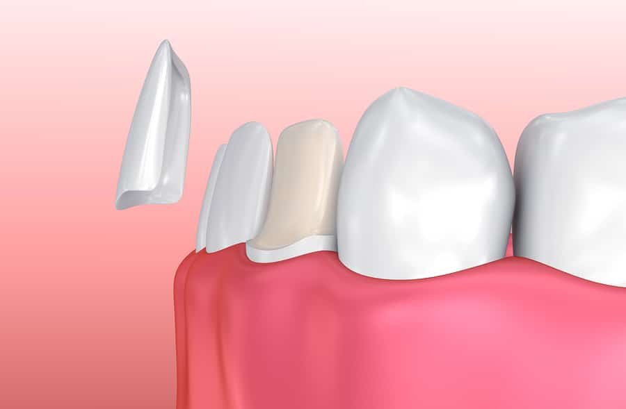 Dental Veneers in viman nagar Pune