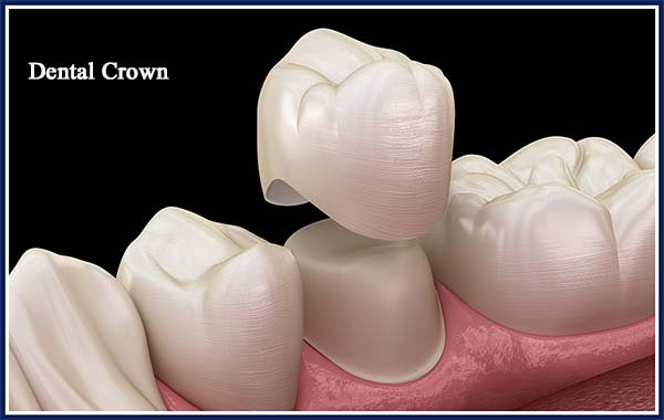 Dental crown dentist in viman nagar pune