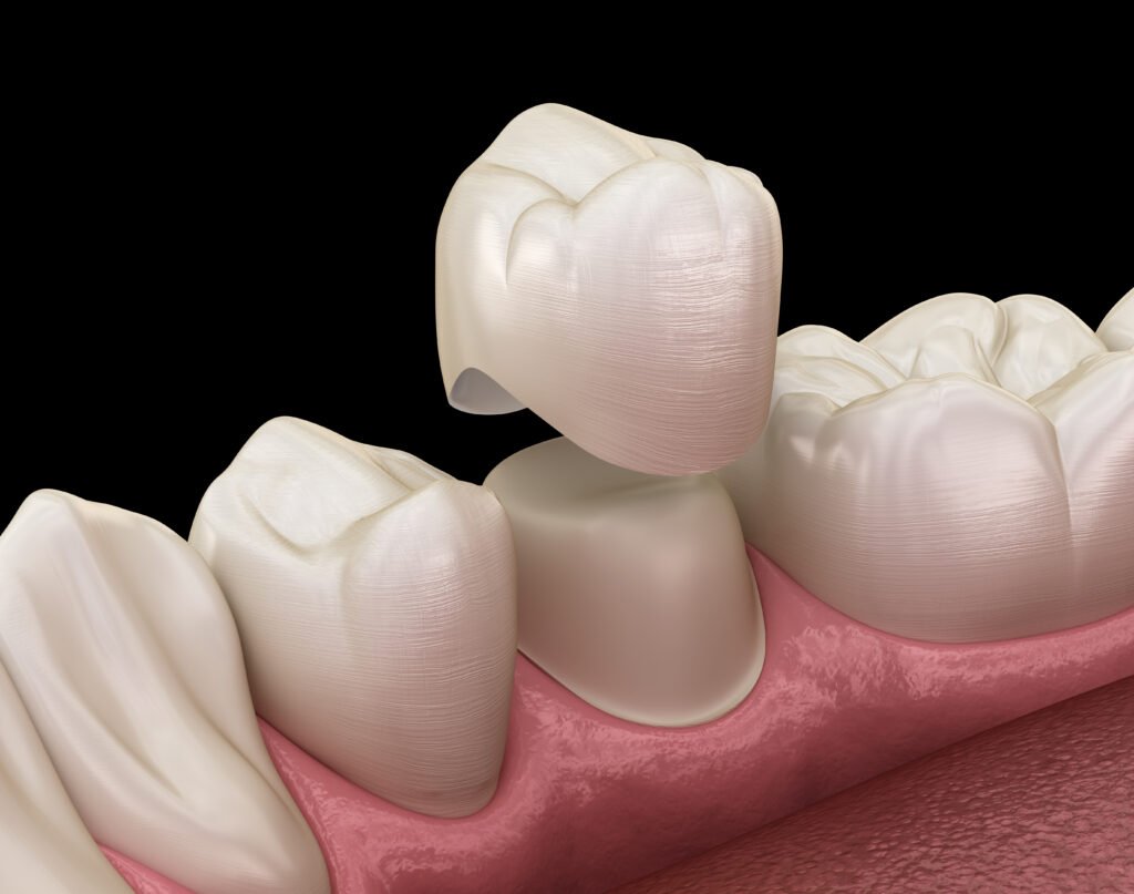 Dental crown dentist in viman nagar pune